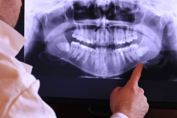 Best Emergency Dentist for Lost Fillings or Crowns in USA